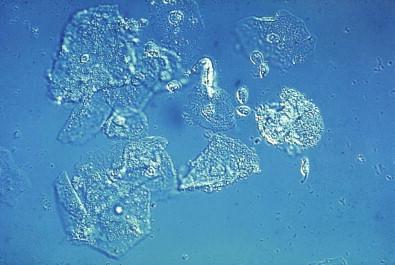 Figure 7-11, “Clue cells” phase contrast. Cervicovaginal smear (unstained, ×MP).