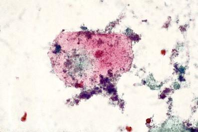 Figure 7-13, Partial obliteration of the squamous cell by the coccobacillary organisms. Cervicovaginal smear (Papanicolaou, ×MP).