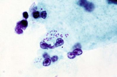Figure 7-17, Gonococcal organisms. These reveal diplococci within the polymorphonuclear leukocytes, and on the surface. Cervicovaginal smear (Papanicolaou, ×OI).