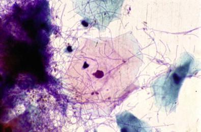 Figure 7-18, Vaginal lactobacillosis. This picture reveals numerous “giant” lactobacilli along with some yeast forms of Candida (Papanicolaou, ×HP).