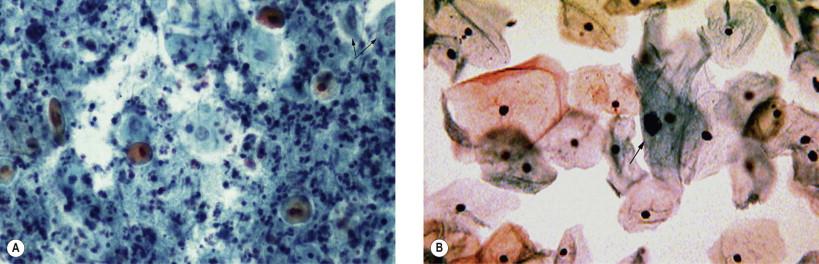 Figure 7-2, Atrophic smear with inflammatory background and some “atypical” cells (arrows). (A) Cervicovaginal smear. (B) Same patient after topical estrogen application. Note the cellular maturation and obvious “atypical” cells (arrow). LBGS (Papanicolaou, ×MP).