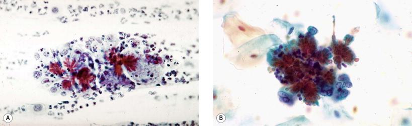 Figure 7-3, Hematoidin crystals , also known as cockleburs, are seen associated with macrophage response. (A) Cervicovaginal smear (Papanicolaou, ×MP). (B) Hematoidin crystals LBGS. Note the clean background and lack of obvious macrophages (Papanicolaou, ×MP).