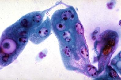 Figure 7-7, Nuclear degeneration among endocervical cells infected with adenovirus infection. Cervicovaginal smear (Papanicolaou, ×HP).