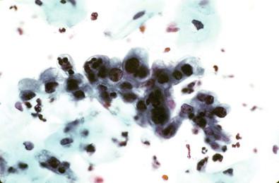 Figure 7-8, Squamous metaplasia (ARC I). LBGS (Papanicolaou, ×MP).