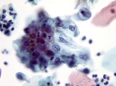 Figure 7-10, Metaplastic changes revealing keratinizing stratified squamous metaplasia (ARC III). LBGS (Papanicolaou, ×MP).