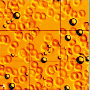 FIGURE 17-1, Contrast agents for ultrasound. (A) Perfluoropropane bubbles with a protein shell (Optison™), seen here against a background of red blood cells. (B) Lipid-coated microbubbles of perfluoropropane gas (Definity™) are seen under a dark field microscope.