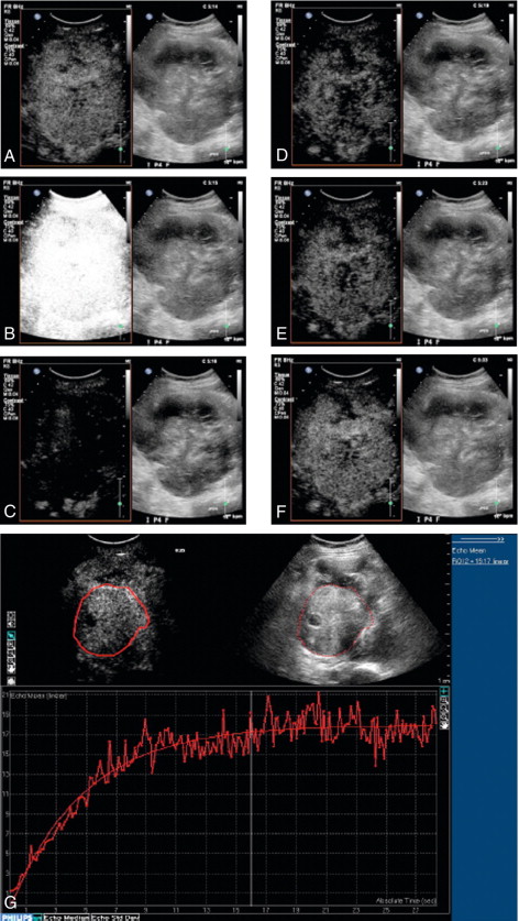 FIGURE 17-3, Dynamic contrast-enhanced ultrasound (DCE-US). Disruption-replenishment imaging used to quantify flow in a renal cell carcinoma in a patient undergoing anti-angiogenic treatment. A sequence of side-by-side contrast images (conventional on right, simultaneous CEUS on left) of a large renal cell carcinoma is made during a steady intravenous infusion of the agent Definity™. (A) t = –1 sec, the tumour is enhanced. (B) t = 0 sec, a brief, high MI ‘flash’ disrupts bubbles within the scan plane. (C) t = 1 sec, new bubbles begin to wash in to the scan plane. (D-F) t = 4 sec, 8 sec and 18 sec after flash, the scan plane is fully replenished. (G) Off-line analysis software measures wash-in for a region-of-interest from the cine-loop record in a similar case. The steeper the slope, the greater the flow rate; the higher the plateau, the greater the vascular volume. Disruption-replenishment imaging thus allows quantitation of tumour flow and total vascular volume.