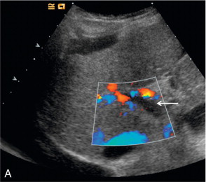 FIGURE 17-4, A commonly seen artifact when using microbubbles is ‘blooming’ in which colour pixels appear to extend beyond the bounds of the vessel. (A) Baseline colour Doppler image at the level of the porta hepatis demonstrating absence of colour signal in the portal vein (arrow) but colour is present in the overlying hepatic artery. (B) Following the administration of SonoVue™ ‘blooming’ from the hepatic artery obscures the portal vein.