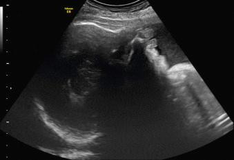 Fig. 68.1, Two-dimensional image of a fetal profile in a case of retrognathia in the third trimester. There is a receding chin with a normal size.