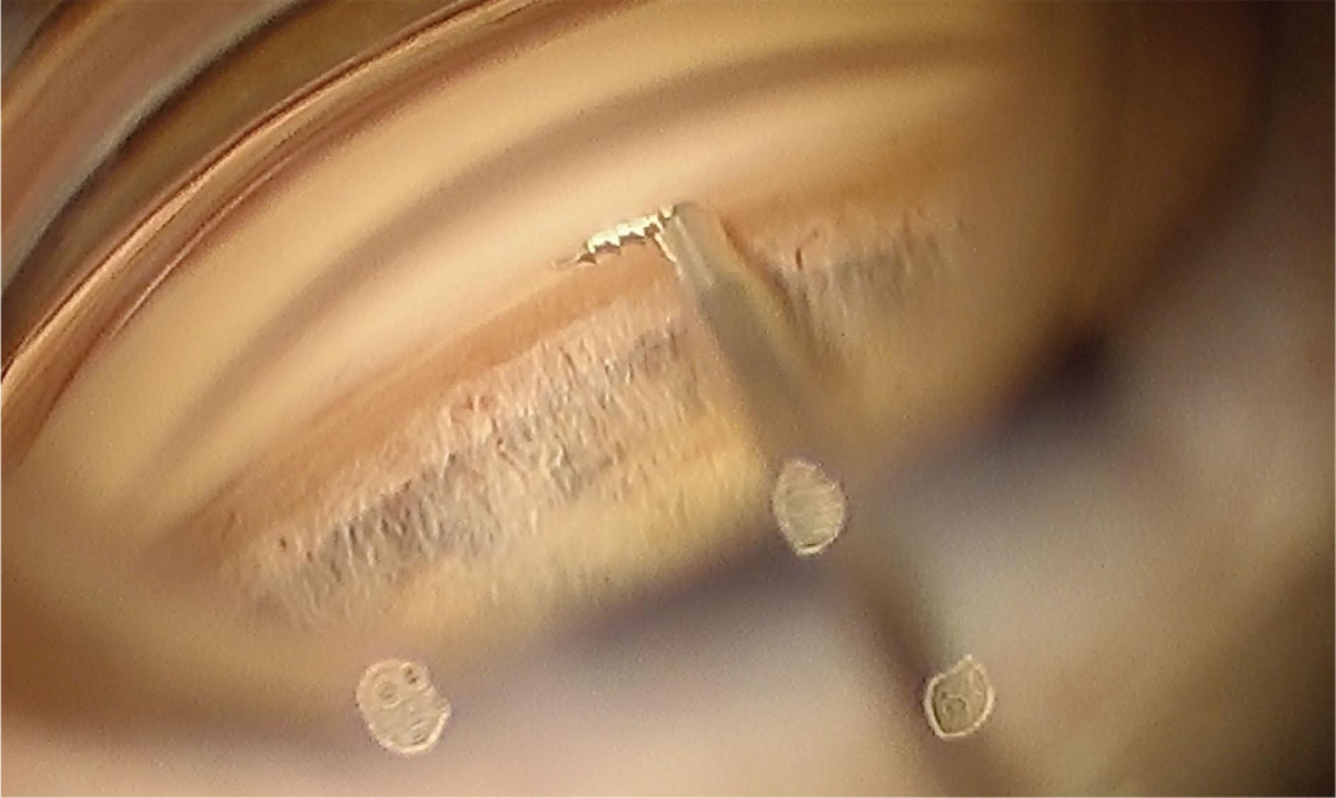 Fig. 10.26.1, iStent G1 before insertion with the tip of the stent engaging the trabecular meshwork.