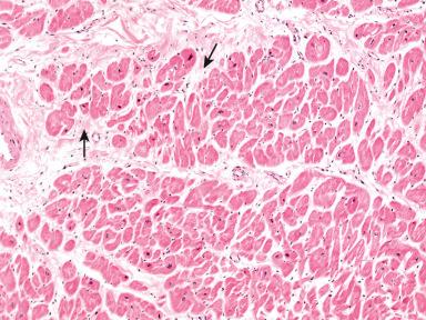 Figure 9-2, Hypertensive heart disease, ×10.