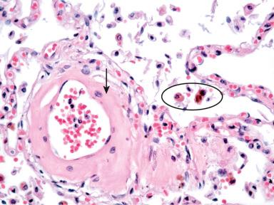 Figure 9-25, Chronic and subacute pulmonary venous congestion.