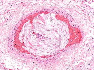 Figure 9-26, Amniotic fluid embolus, lung.
