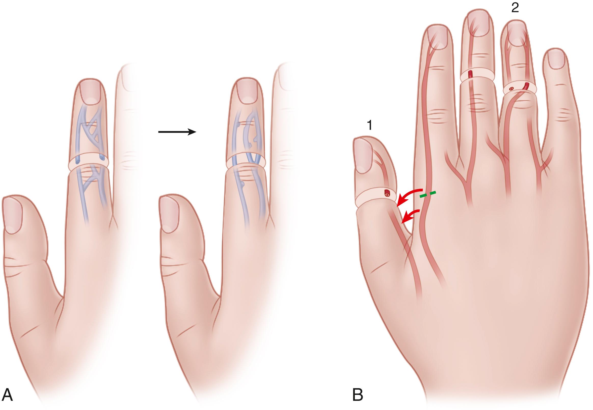 FIGURE 63.12, Vessel shifting. A, Dorsal veins mobilized to provide additional distal veins for proximal anastomosis. B, Arteries mobilized to allow shifting of artery from intact digit to vascularize thumb (1) and within same digit to vascularize distal amputated part (2). SEE TECHNIQUE 63.5.