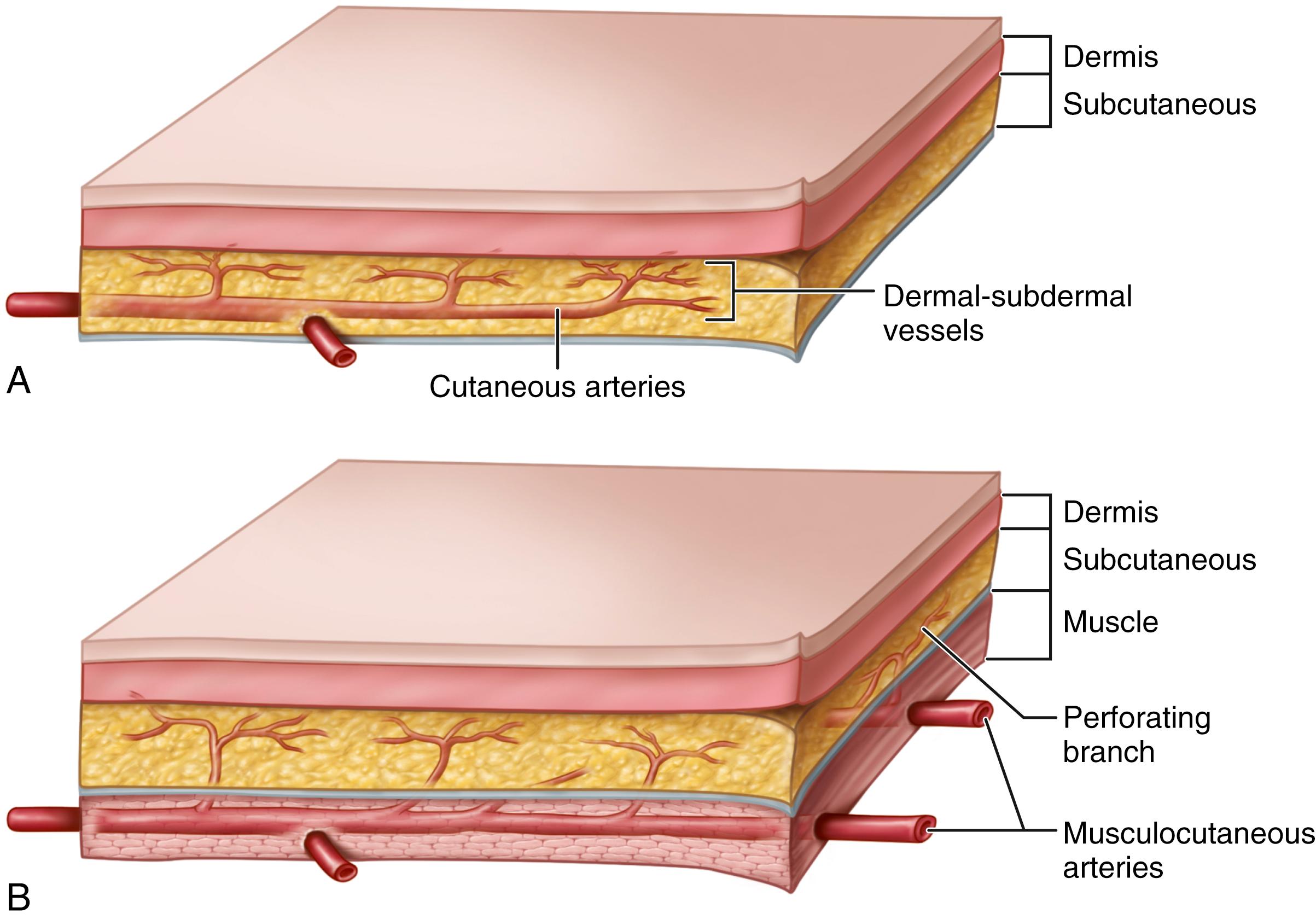 FIGURE 63.13, Arterial supply to axial pattern flaps. A, Cutaneous flap, relying on single artery supplying dermal and subdermal vessels. B, Myocutaneous flap, relying on deep musculocutaneous arteries perforating muscle and fascia to overlying skin.