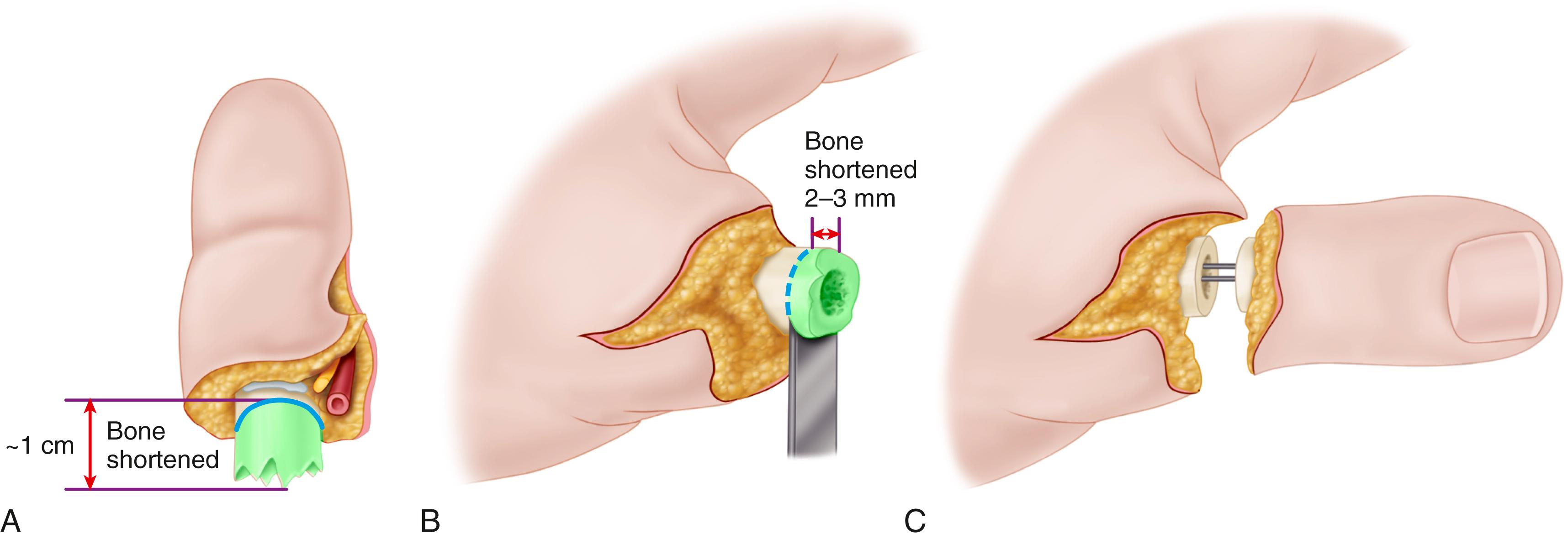 FIGURE 63.10, Bone management. A, In digits, shortening of 1 cm usually allows tension-free vessel anastomosis without excessively impairing hand function. B, Shortening of thumb proximal phalanx with oscillating saw in 2- to 3-mm increments until satisfactory shortening is achieved. C, Bone fixation with longitudinal Kirschner wires usually is sufficient.