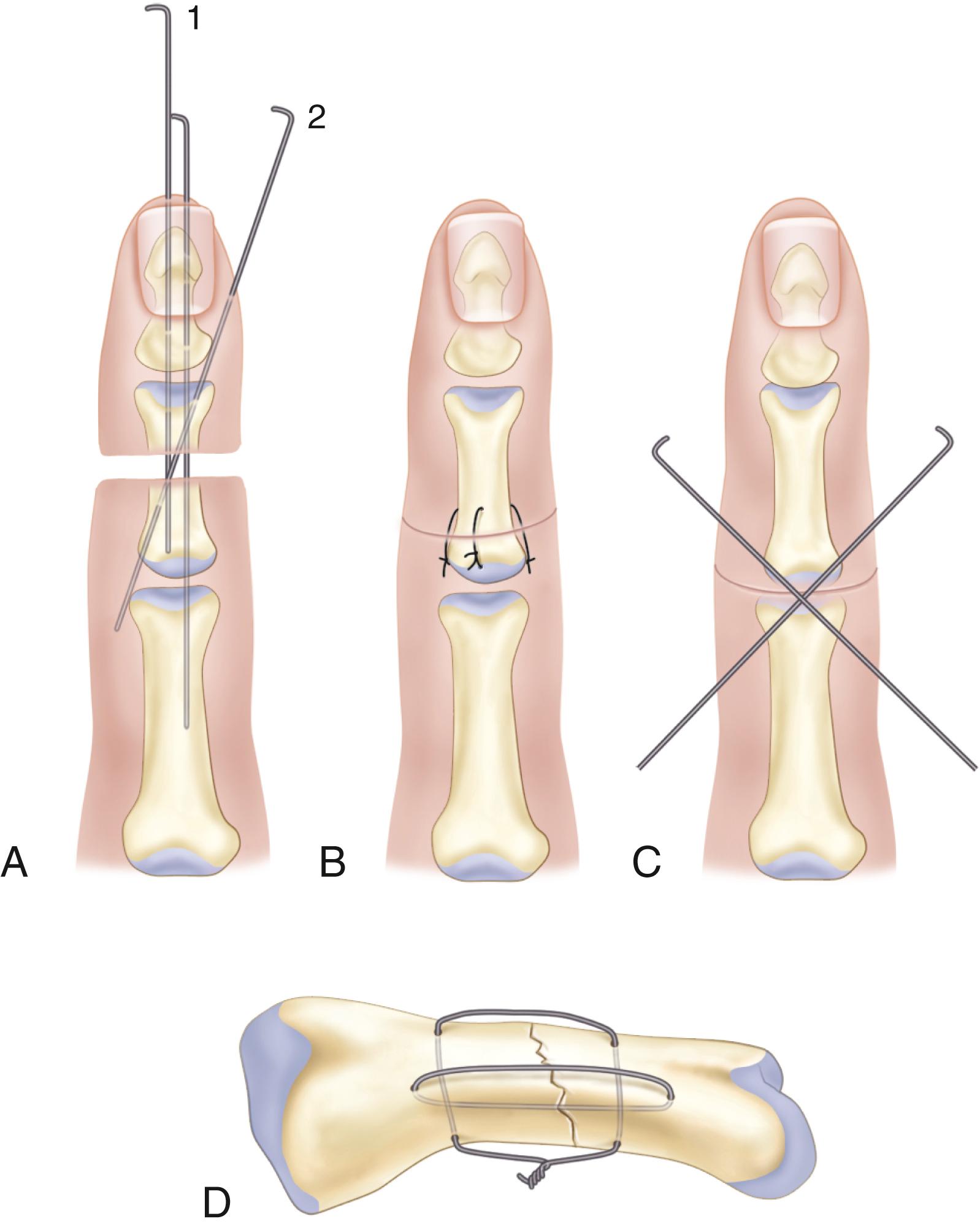 FIGURE 63.11, Bone fixation. A, Fixation usually is achieved with two parallel Kirschner wires (1) or single Kirschner wire supplemented with oblique wire (2). B, Wire loop fixation suitable for amputation near undamaged joint. C, Primary arthrodesis with crossed wires for amputation through irreparably damaged joint. D, Intraosseous wires.