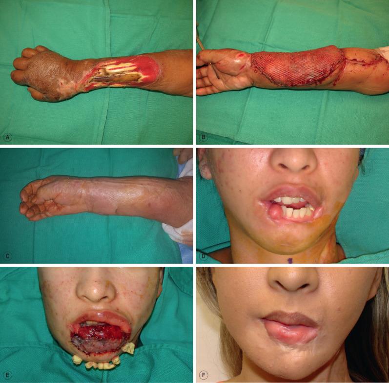 FIG. 2.7.2, (A) A large forearm wound with exposed bone and necrotic tendon. (B) The wound was debrided, and a latissimus muscle was used to cover the defect. A meshed split-thickness skin graft was placed on the muscle. (C) The muscle atrophied and had good contour. It can be elevated for later bone grafting (as in this case) or for tendon transfer or grafting. (D) A full-thickness loss of the lower lip and orbicularis muscle after necrotizing infection. (E) A functional gracilis muscle was used to reconstruct the orbicularis by innervating to the marginal mandibular nerve while bilateral facial artery musculomucosal flaps were used for lip vermilion. (F) The patient after 1 year has good oral competence and excellent aesthetic outcome.