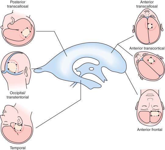 Figure 46.4, Approaches to the ventricular system. A composite of various approaches to the cerebral ventricles is illustrated. The optimal approach provides the surgeon with a perpendicular line of sight to the lesion within short working distance while minimizing functional deficits from manipulating surrounding structures. The site of the skin incision and the bone flap are shown for each approach to the specific part of the ventricle. (The incisions can be curvilinear as shown, linear, serpentine, or zigzag, depending on surgical preference. The cranial bone flap can be shaped to provide appropriate exposure.)