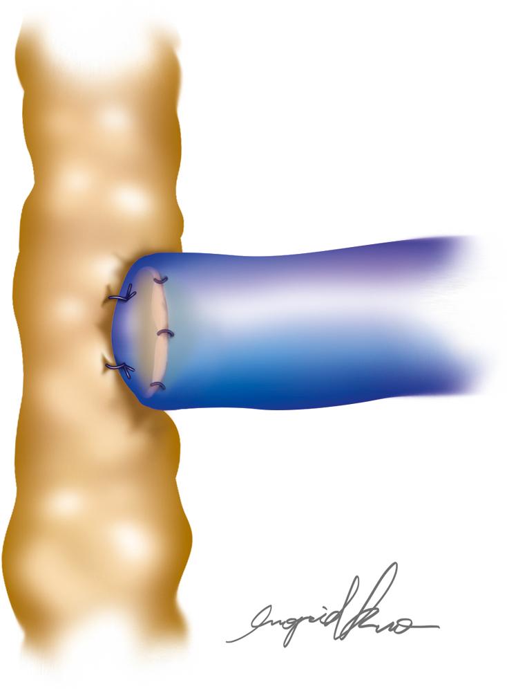 Fig. 20.2, Side-to-End Technique.