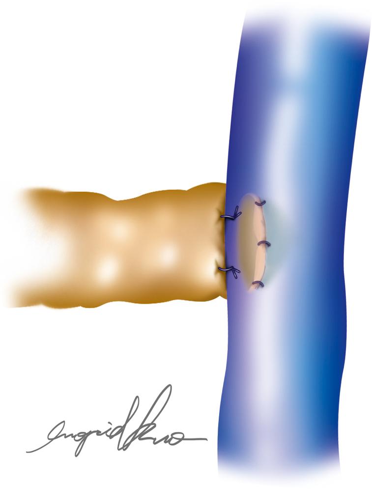 Fig. 20.3, An end-to-side technique may be used to eliminate the chance of venous regurgitation to the lymphatic system.