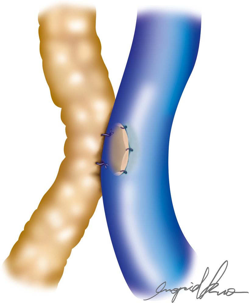 Fig. 20.4, Side-to-Side Technique.