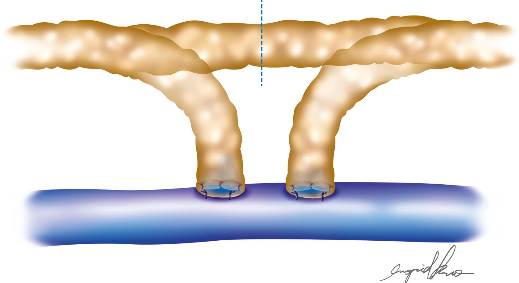 Fig. 20.5, Double End-to-Side Technique.