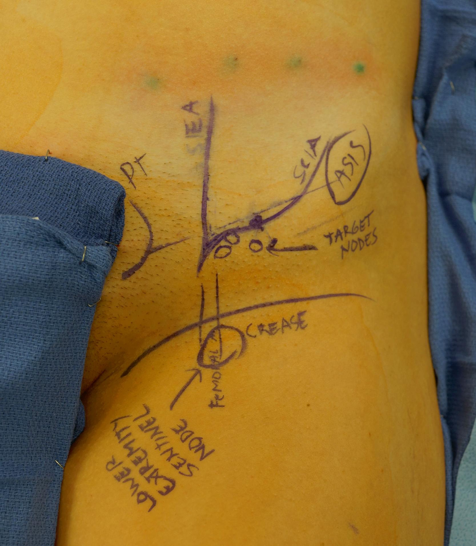 Fig. 19.1, Preoperative markings demonstrating the location of the superficial circumflex iliac artery–based inguinal nodes confirmed by indocyanine green lymphangiography. A gamma probe localized the lower limb sentinel node below the groin crease as a marker.