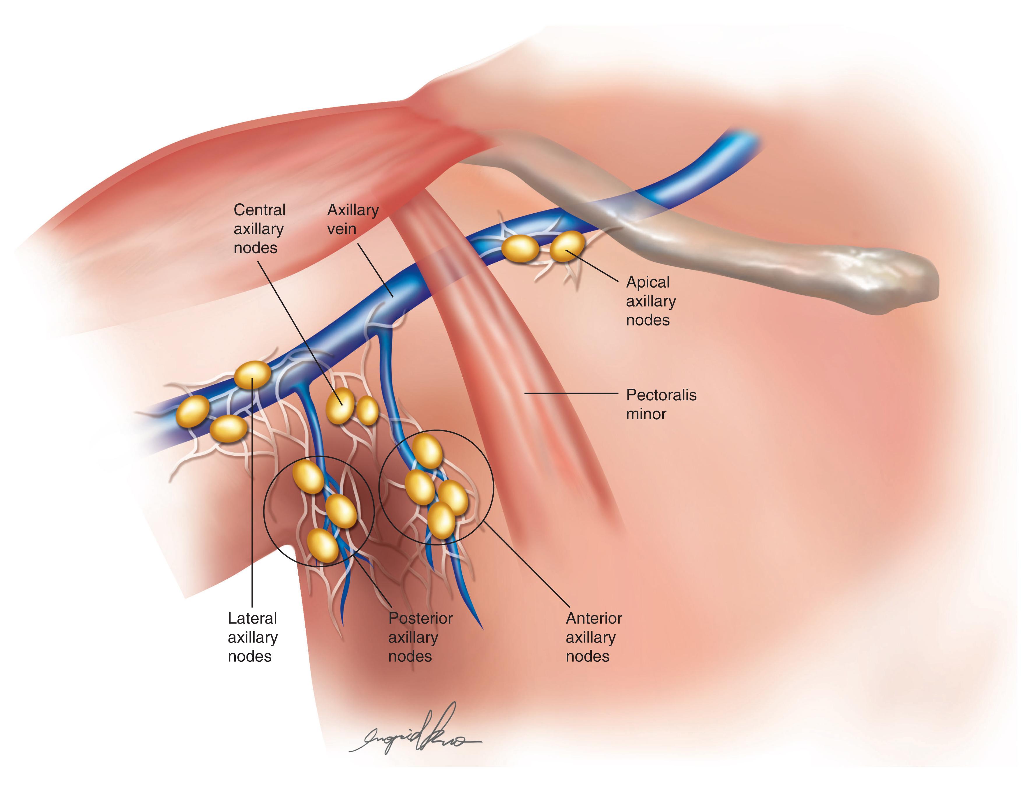 Fig. 16.1, Anterior and Posterior Lymph Node Groups Along the Lateral Thoracic and Thoracodorsal Vessels, Respectively.