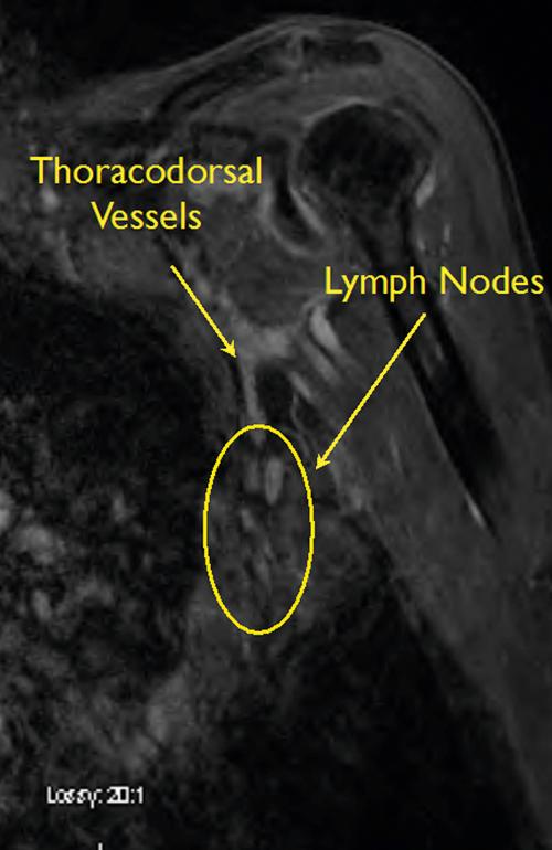 Fig. 16.2, Magnetic Resonance Angiography Demonstrating the Location and Quantity of Axillary Lymph Nodes and Relationship to Donor Vessels.