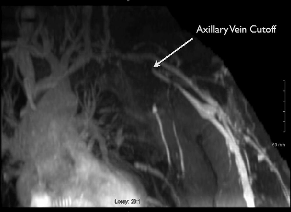 Fig. 16.4, Magnetic Resonance Angiography Demonstrating the Constriction of Axillary Vein at the Recipient Site.