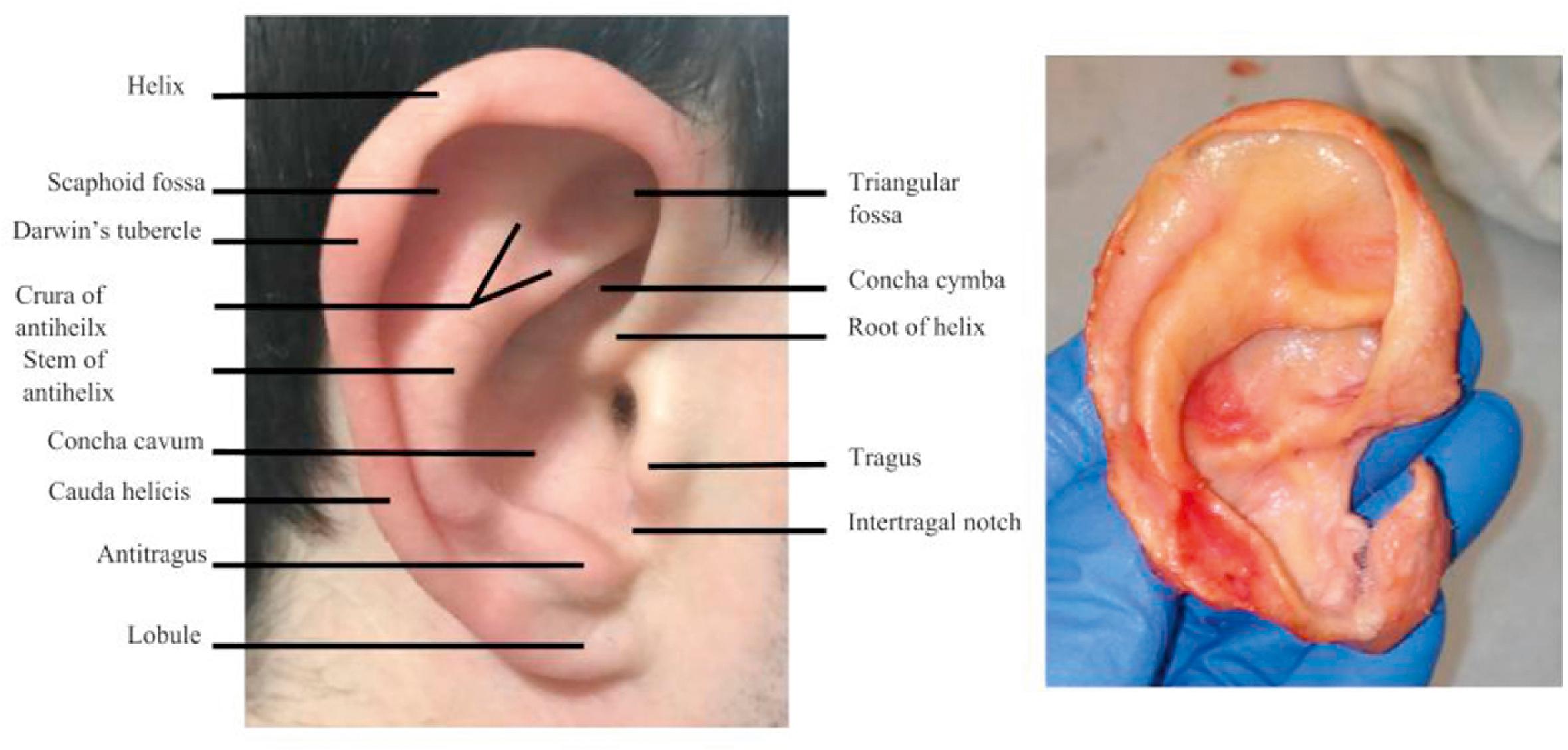 Fig. 18.1, Normal anatomic landmarks of the pinna and underlying cartilage framework.