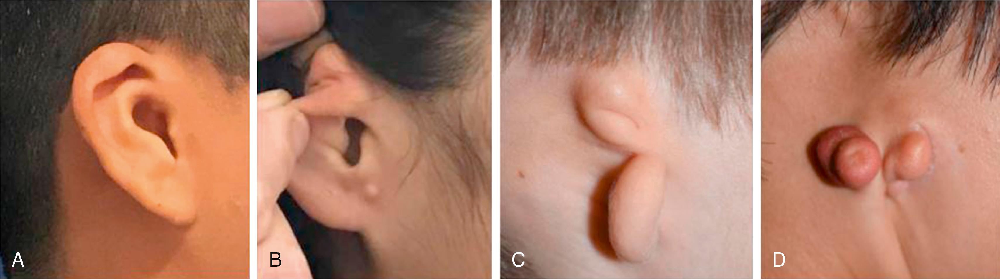 Fig. 18.2, (A) Type I microtia with constricted ear and minimal tissue deficiency. (B) Type II microtia, conchal type: absence of superior portions of the ear and preservation of inferior conchal anatomy. (C) Type III microtia, lobular type: markedly deformed and no identifiable concha and preservation of the lobule. (D) Type IV, anotia.