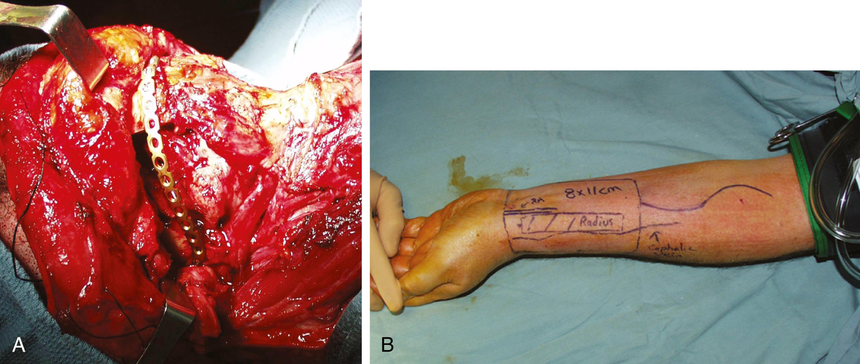 Fig. 162.1, Osteocutaneous radial forearm free flap for a lateral mandibular defect.