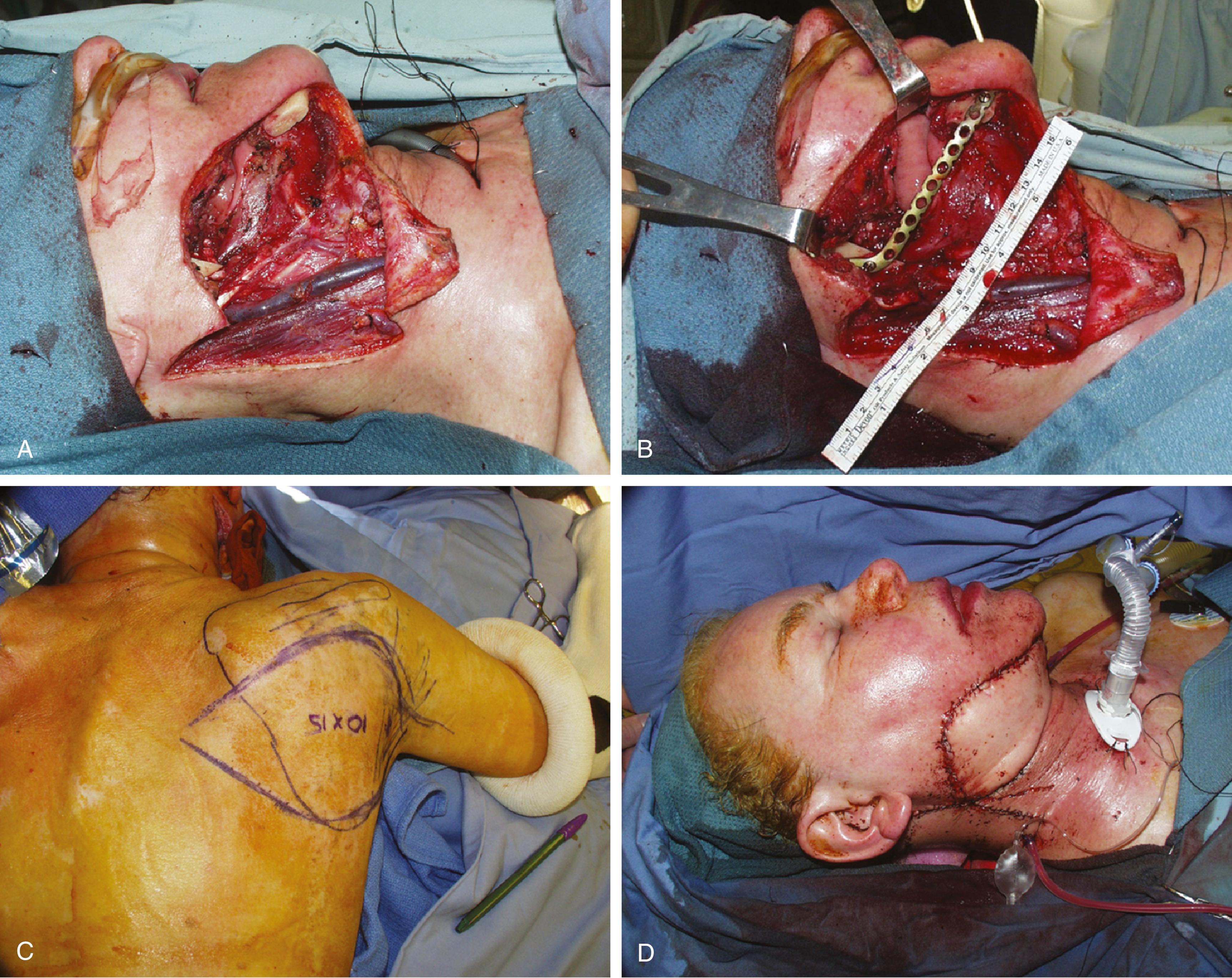 Fig. 162.2, Scapular fasciocutaneous flap.