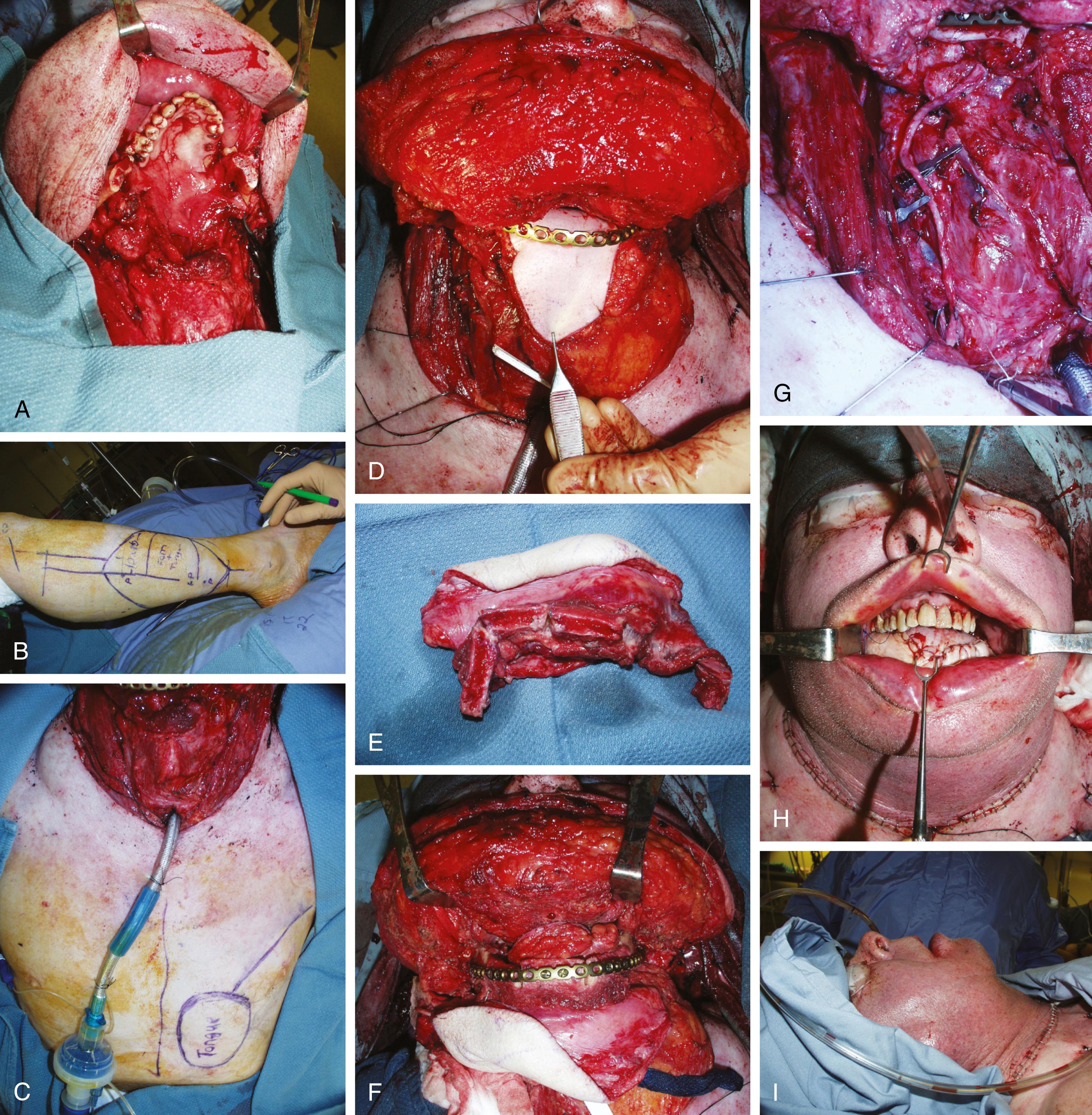 Fig. 162.3, Fibular osteocutaneous free flap and pectoralis major myocutaneous flap for near total mandibulectomy and total glossectomy.