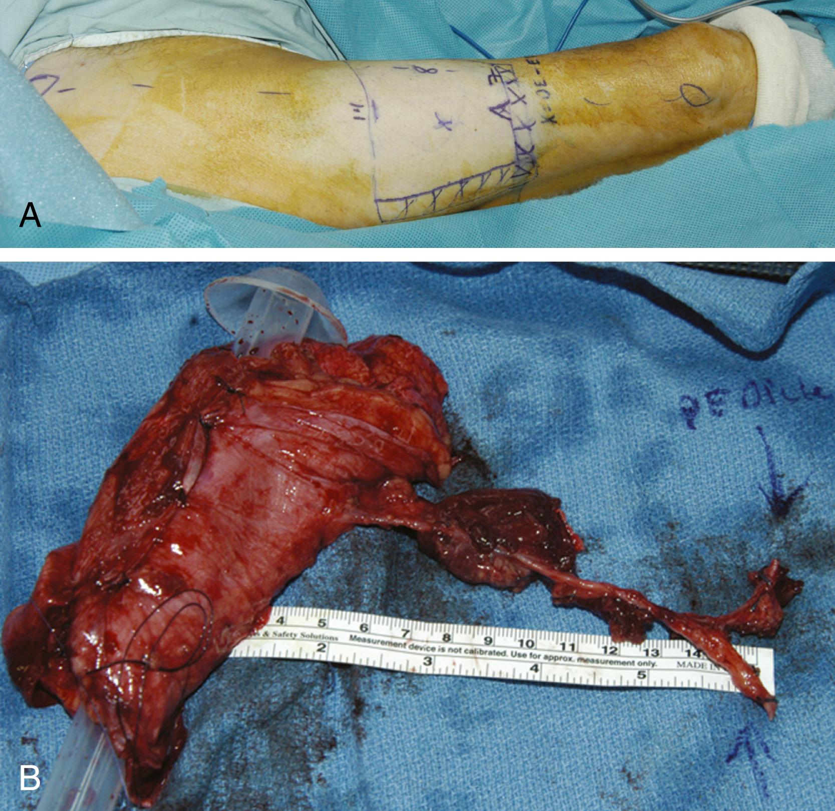 Fig. 162.4, Anterior lateral thigh flap.