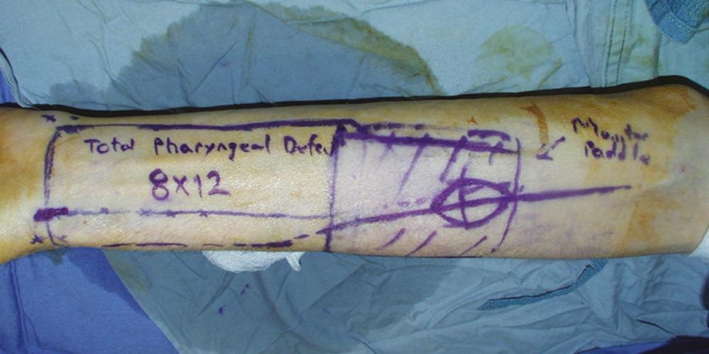 Fig. 162.5, Total pharyngeal reconstruction with a radial forearm free flap (RFFF) harvested with a monitor paddle. Flap design with monitor paddle.