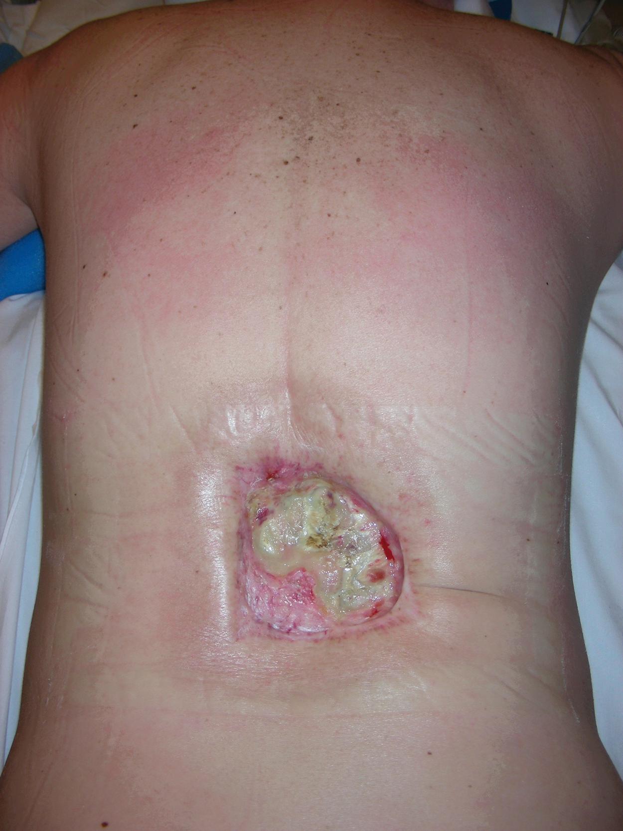 Fig. 29.1, Preoperative view showing a large radiation wound, measuring 10 × 9 cm, located in the lower middle and upper lower back.
