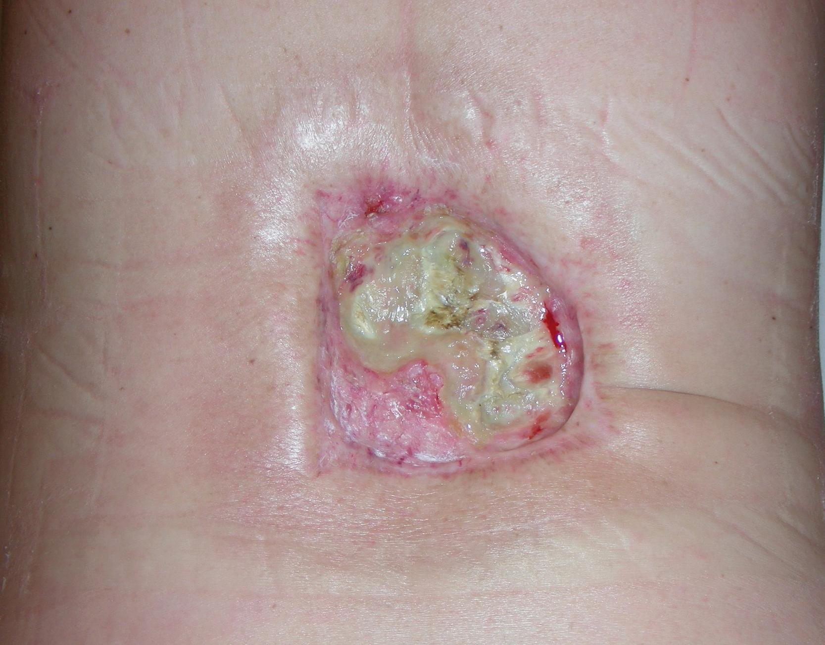 Fig. 29.2, Intraoperative close-up view showing a complex back wound with fibrotic and necrotic tissues and exposed spinal processes.