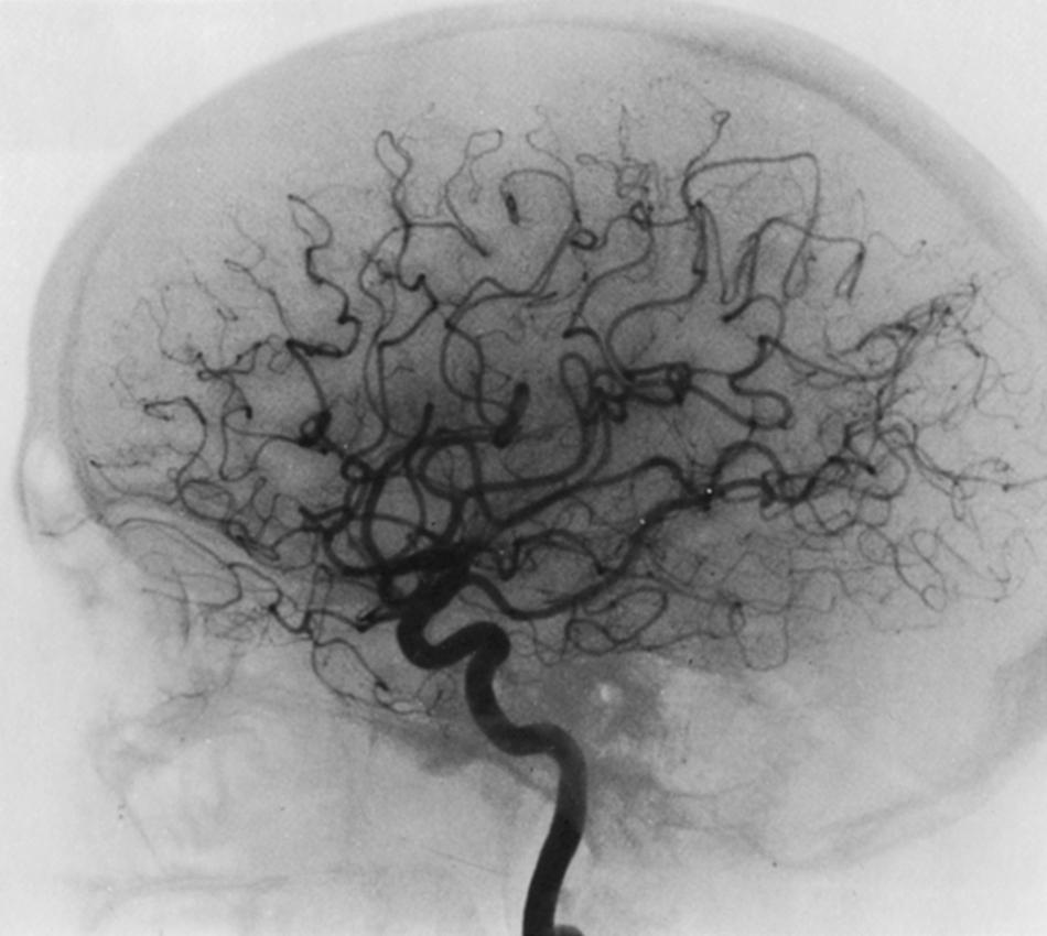 Fig. 24.1, Lateral view of the middle cerebral artery anatomy.