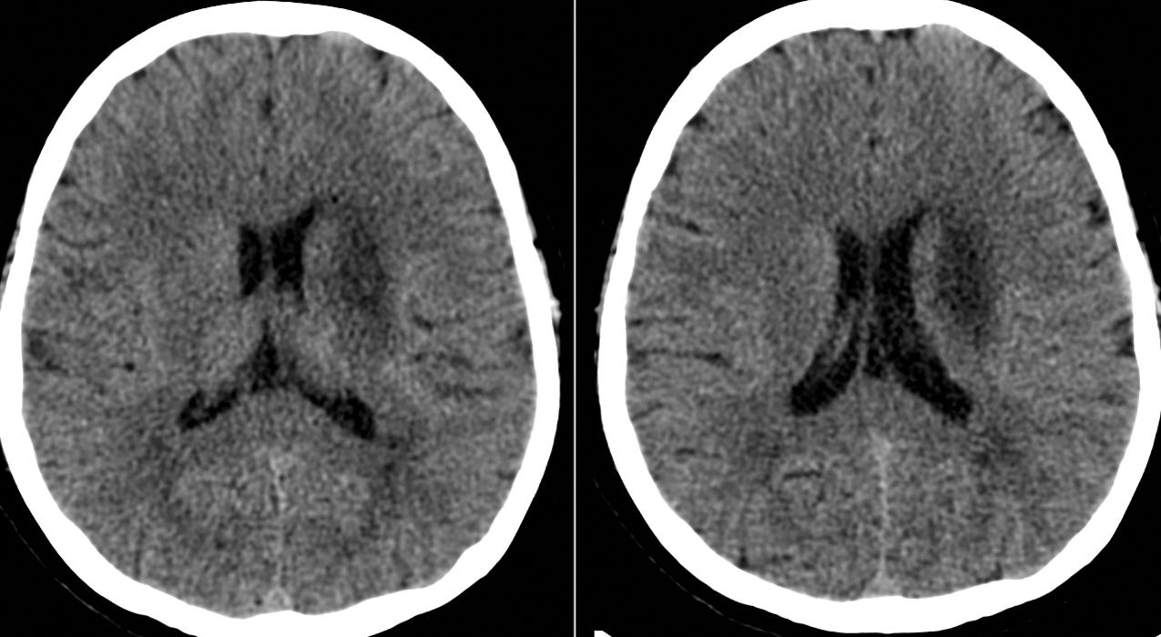 Fig. 24.11, Large deep infarction of the middle cerebral artery lenticulostriate territories shown by CT scan.