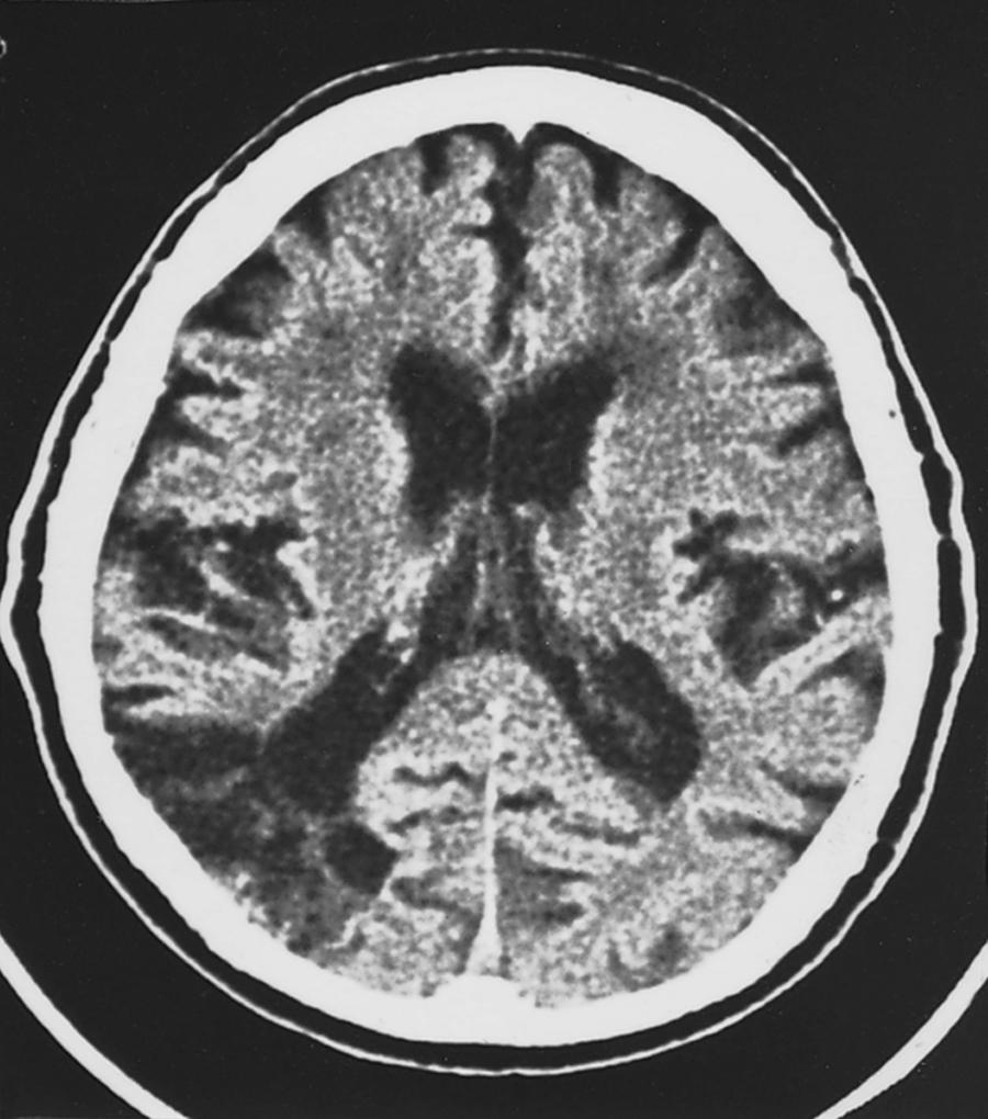 Fig. 24.12, Axial CT scan showing a left parietal infarct in a patient with right inferior quadrantanopia.