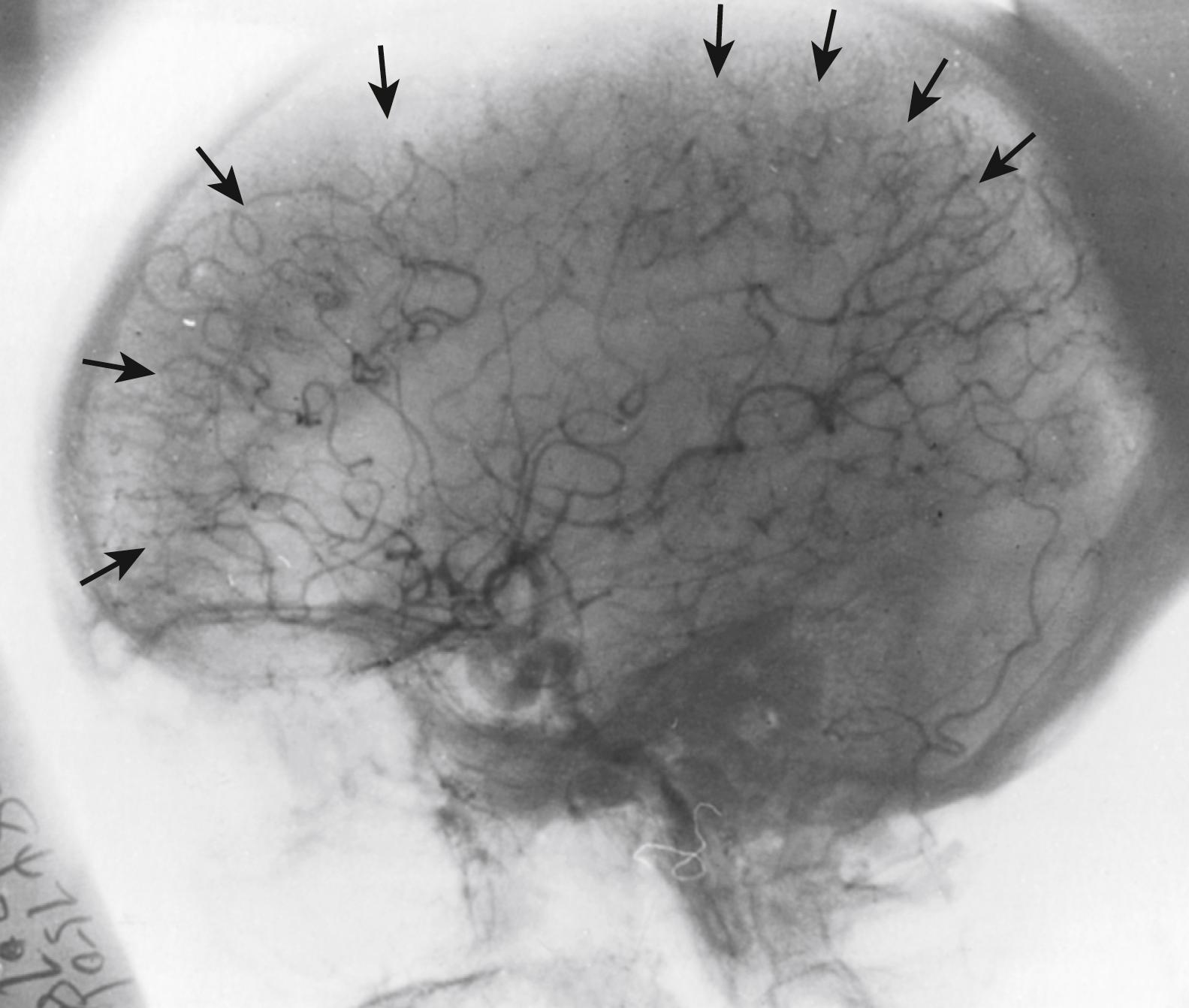 Fig. 24.2, Anatomy of the borderzone anastomoses (individual anastomoses shown by arrows ).