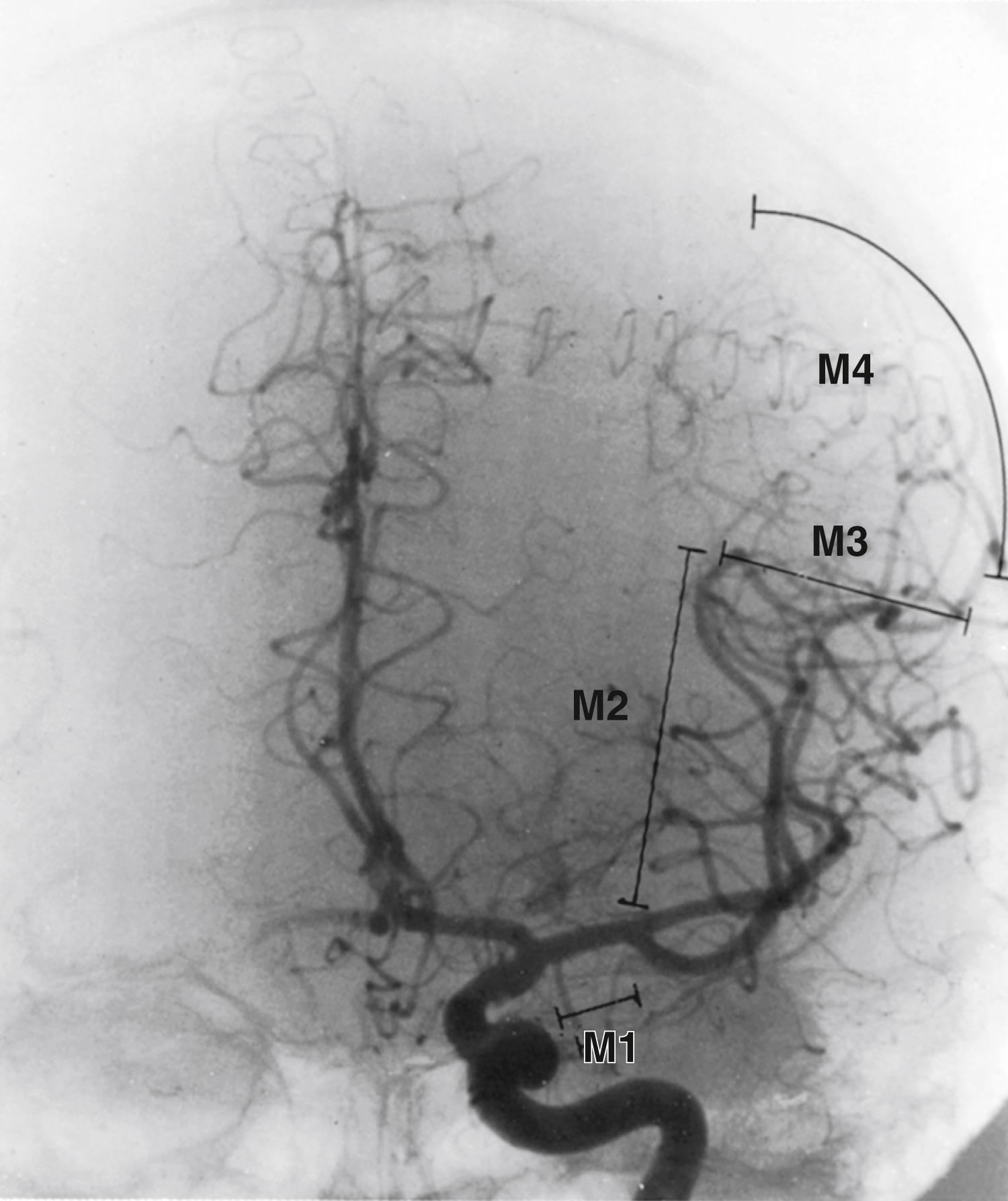 Fig. 24.3, Classification of the middle cerebral artery by segments.