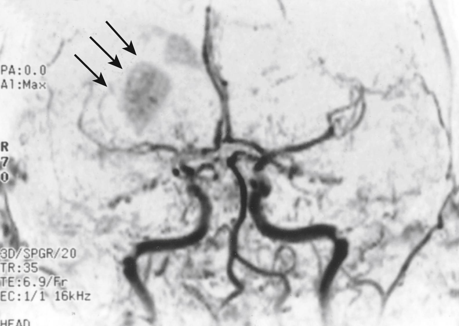 Fig. 24.4, Hemorrhagic infarction (arrows) shown in the deep (lenticulostriate) territories of the middle cerebral artery on a coronal MR image.