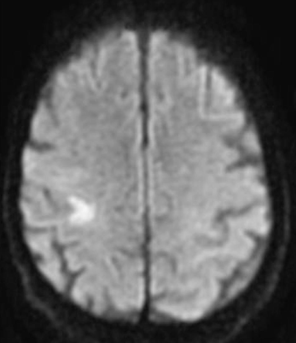 Fig. 24.6, Brain imaging showing a high rolandic focal infarct in a patient with acute distal brachial plegia, normal after 1 month.