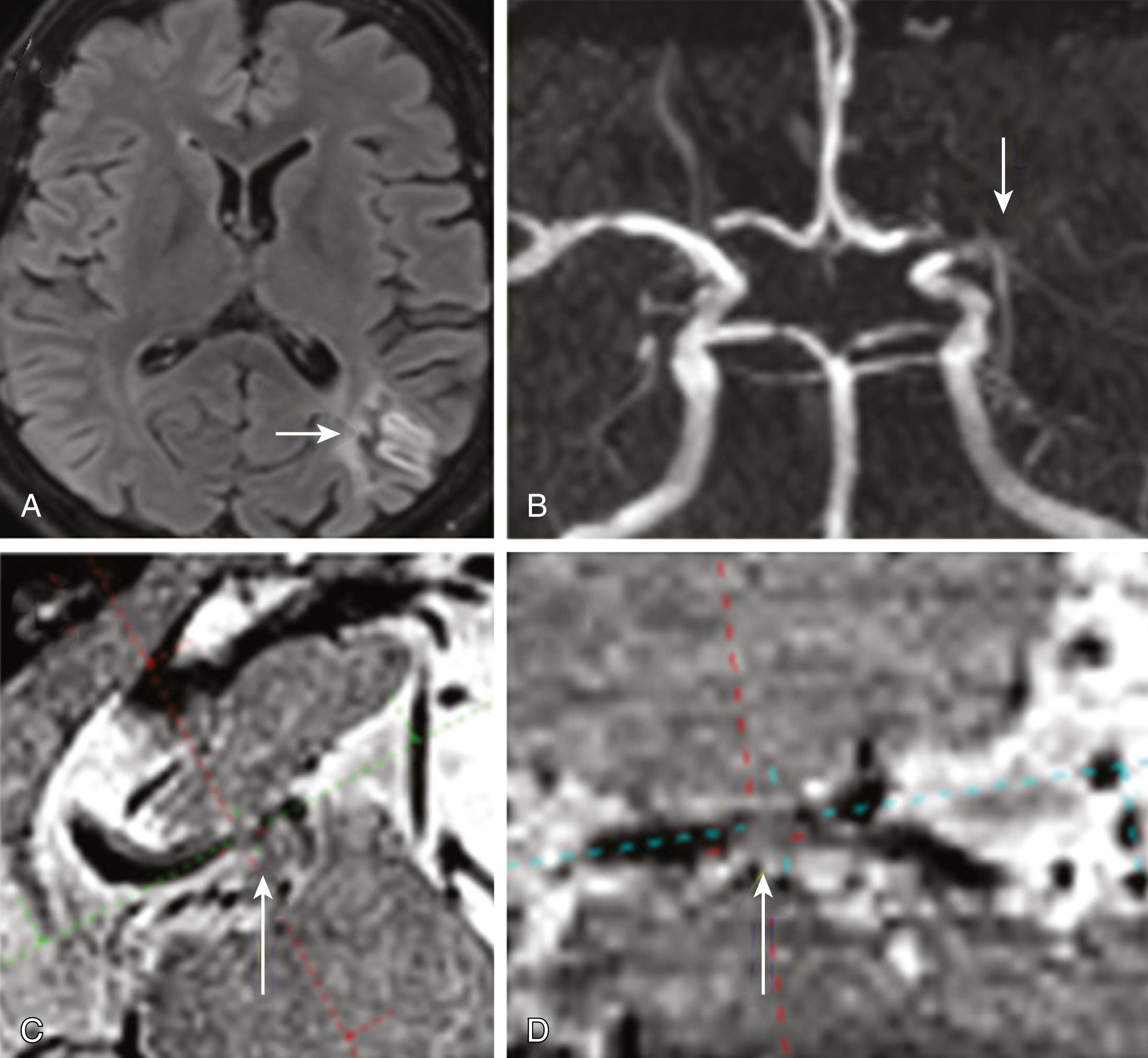 Fig. 24.7, High-resolution MRI in a patient with left posterior watershed infarction (A) due to severe stenosis of the left middle cerebral artery (B). Although time-of-flight MR angiogram showed an occlusion of proximal left middle cerebral artery (MCA), high-resolution MRI showed an atherosclerotic plaque and severe stenosis (C) that resulted in complete occlusion of the distal MCA (D).