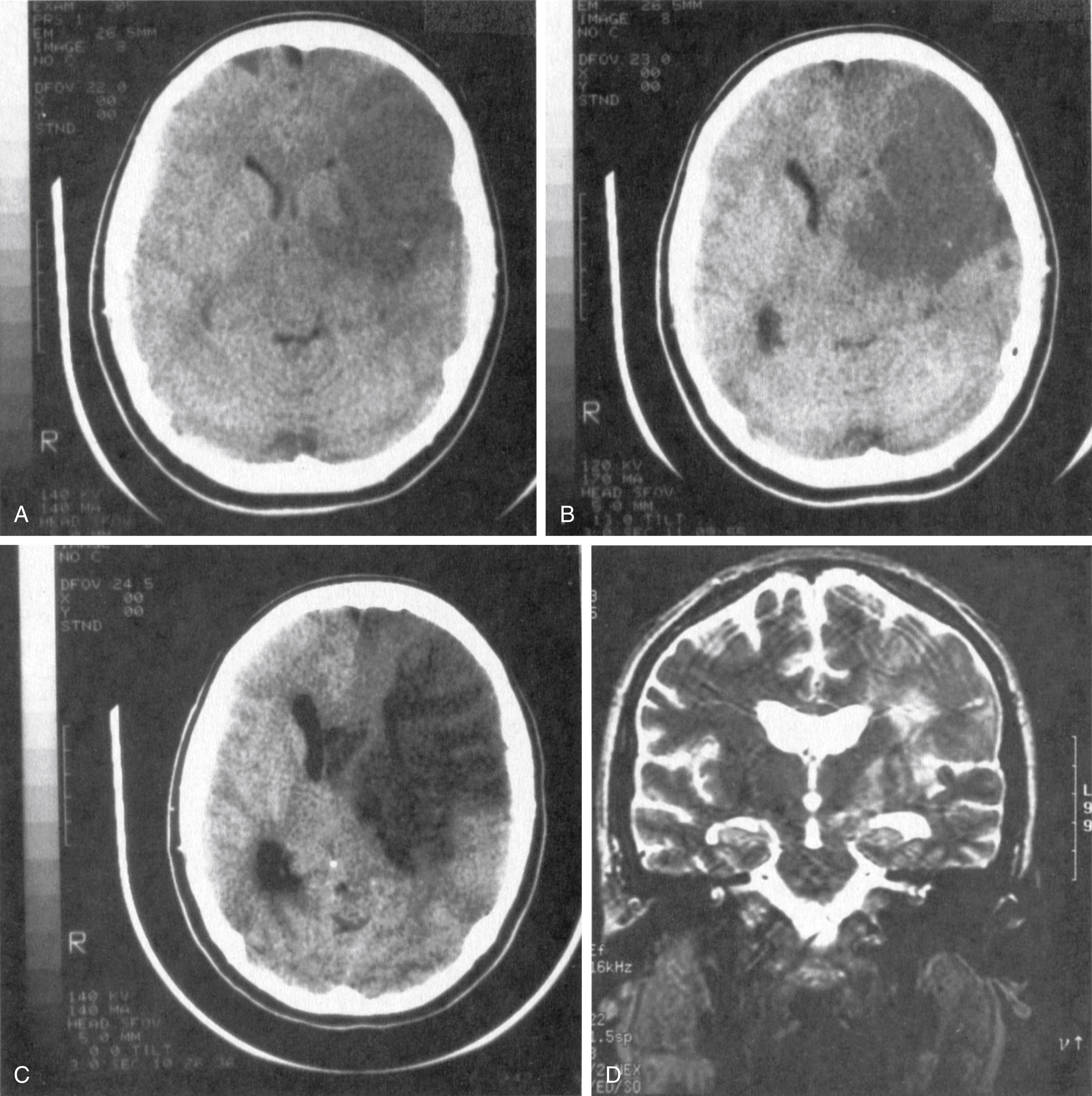 Fig. 24.8, Four stages of midbrain compression. (A) Viewed from an axial CT scan, the large middle cerebral artery (MCA) territory infarction has just begun to produce slight displacement a few hours after the acute stroke. (B) By the second day, edema and “mass effect” have displaced the midbrain and thalamic structures slightly across the midline. (C) By the fourth day, at the height of compression, the midline structures have been rotated and displaced considerably, during which time the patient appeared in a state of uncal herniation. (D) A week later, a coronal T2-weighted MR image shows the midline structures back at their normal positions, and no lasting damage is evident from the displacement.