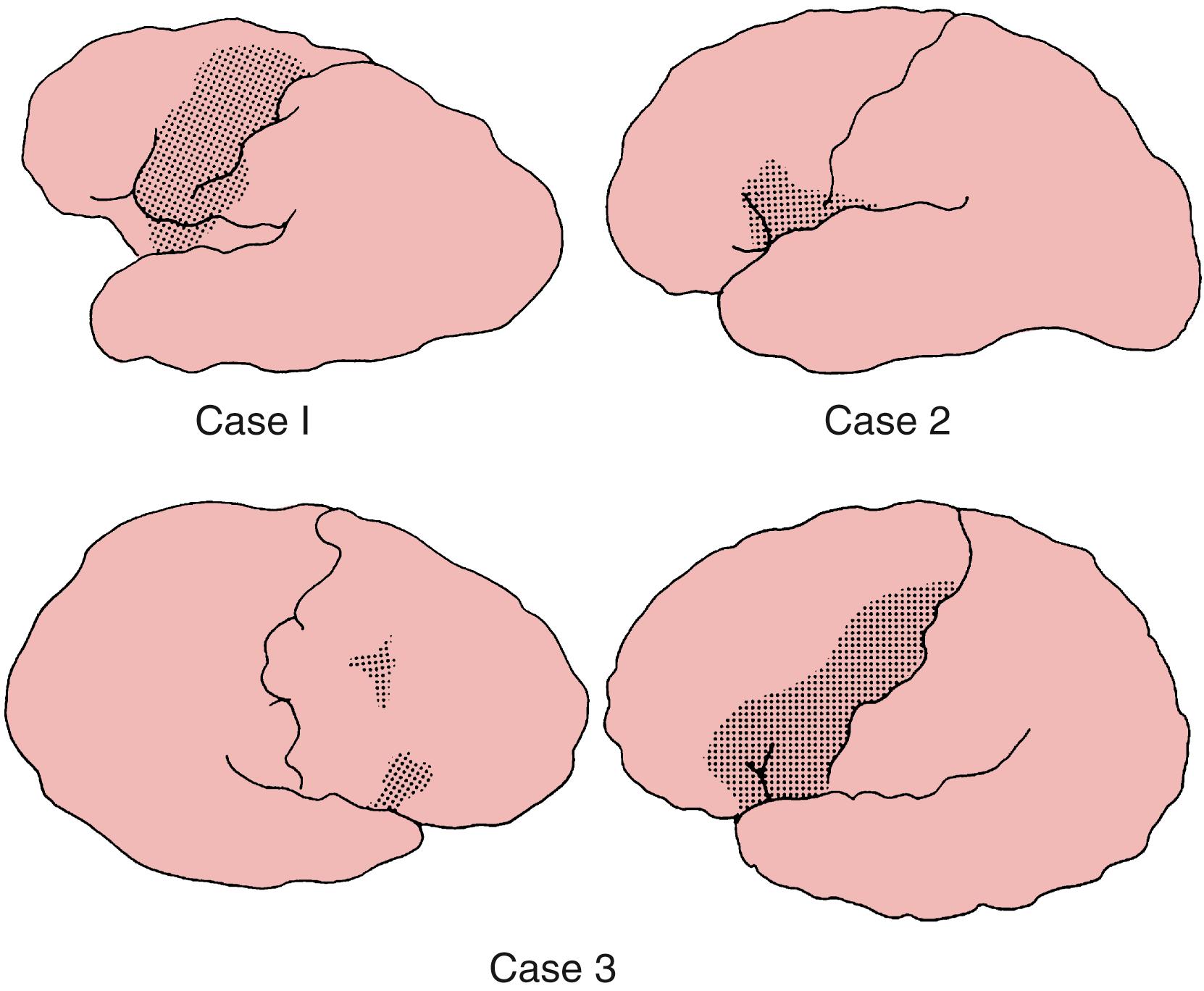 Fig. 24.9, Three examples of embolic infarction of Broca area and surrounding cerebrum.